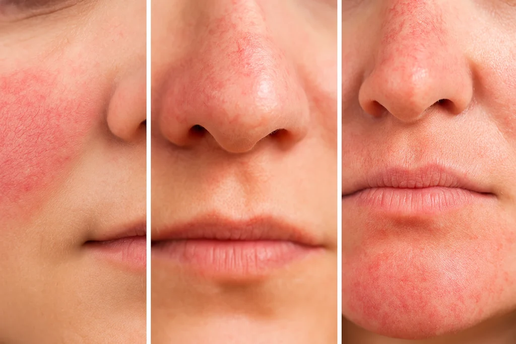 Distintas zonas del rostro con piel rosácea