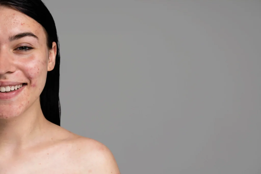 Mujer adulta con acné leve mostrando seguridad y aceptación durante el tratamiento.