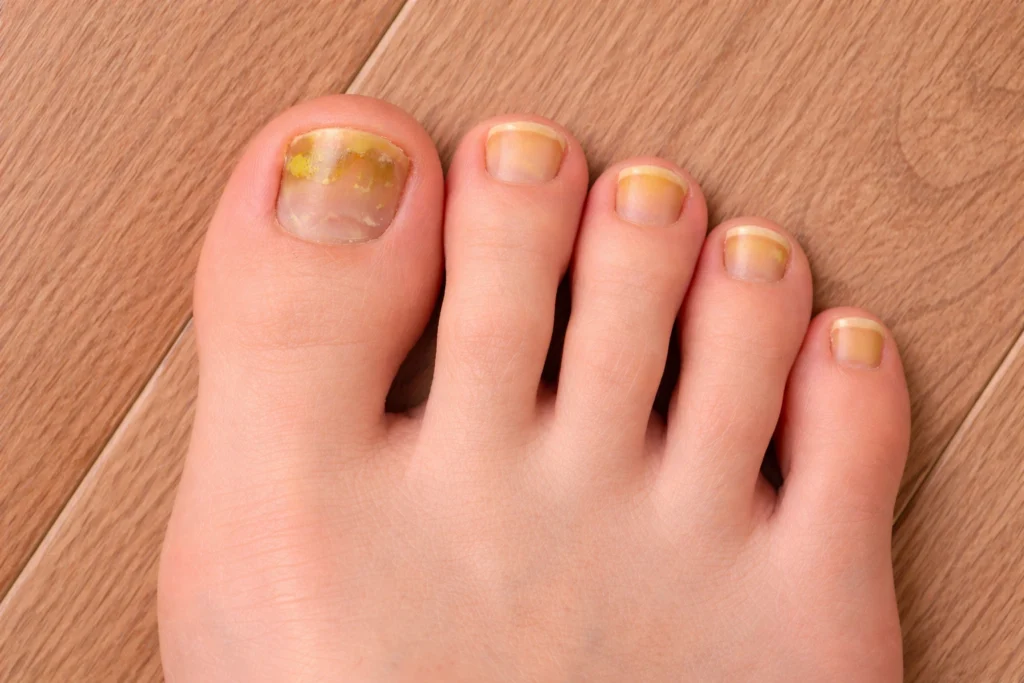 Pie con onicomicosis