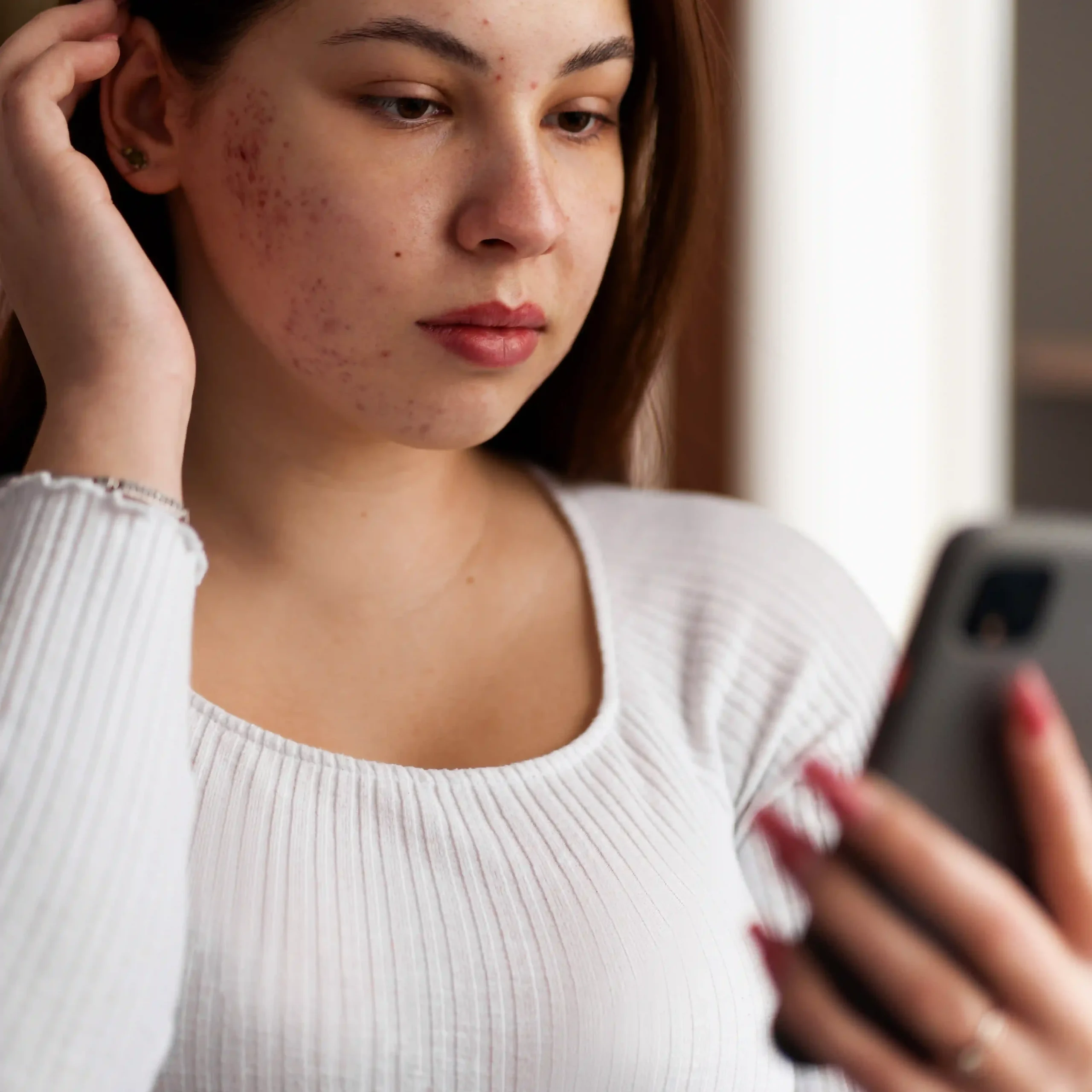 Mujer revisando la evolución de su acné adulto durante un tratamiento dermatológico.