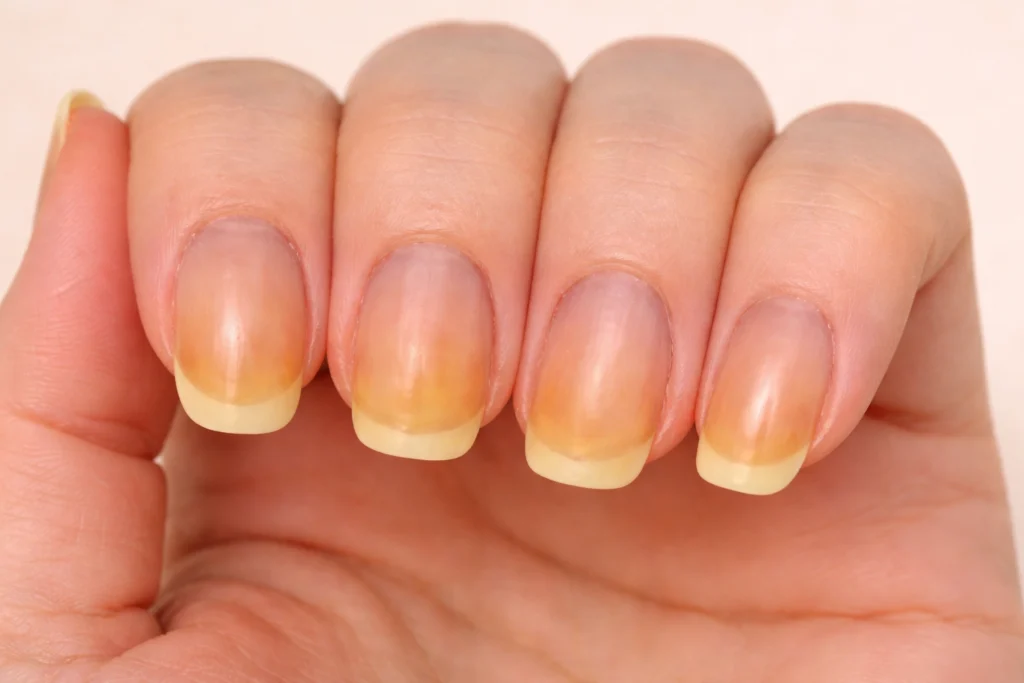 Mano con uñas amarillentas