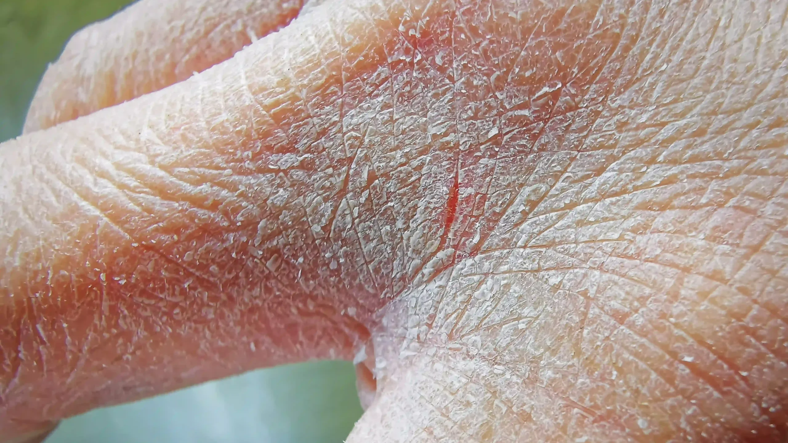 Piel extremadamente seca