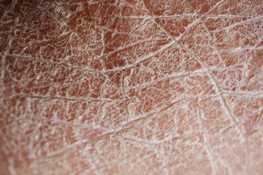 Zoom de piel deshidratada