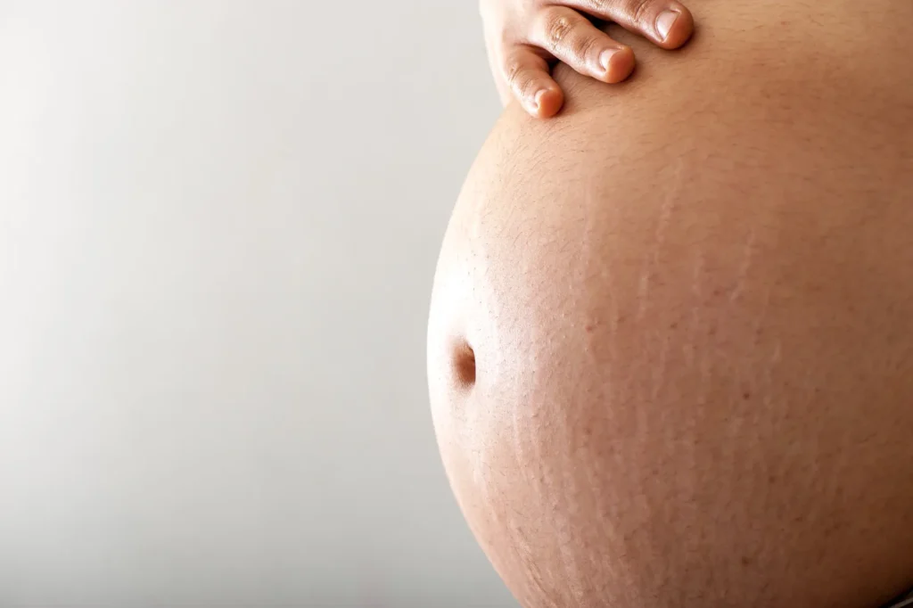 Primer plano de vientre con estrías en el embarazo en la zona abdominal.
