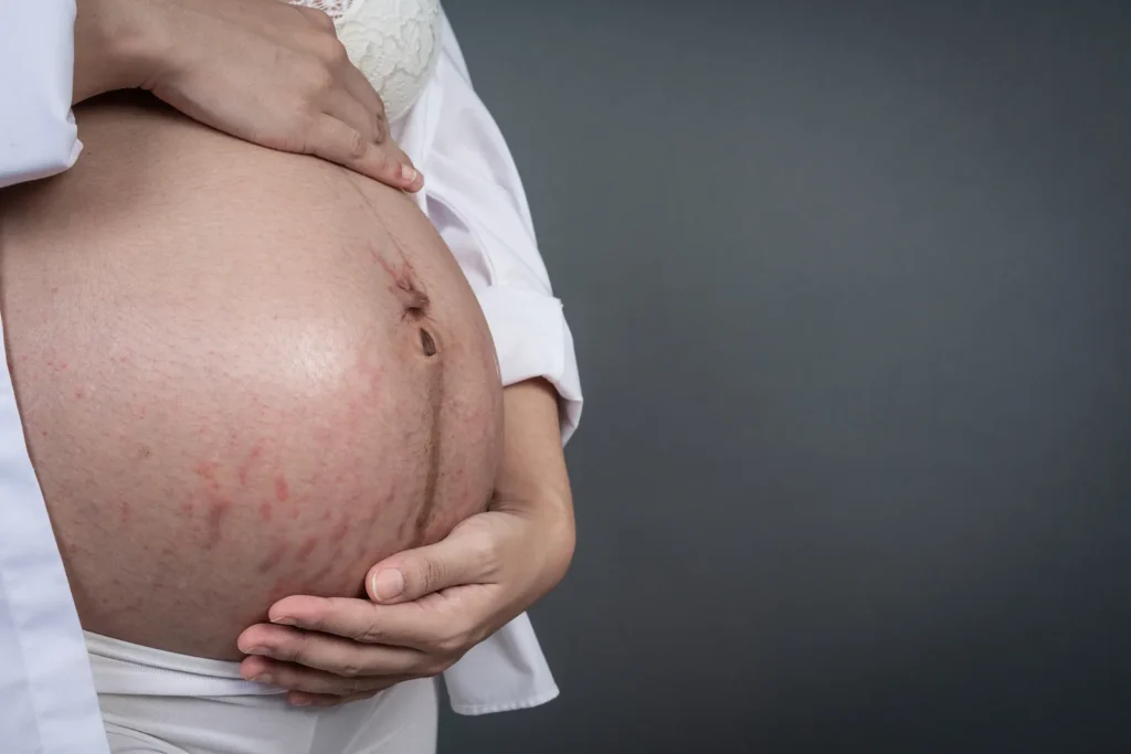 Abdomen de embarazada con estrías rojizas recientes visibles en la piel.