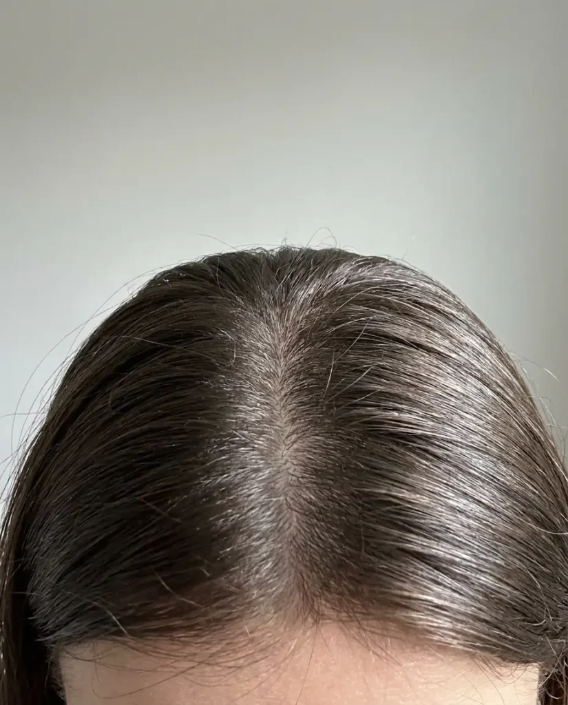 Raya del pelo con la raíz aplastada y brillante, señal típica de cabello graso